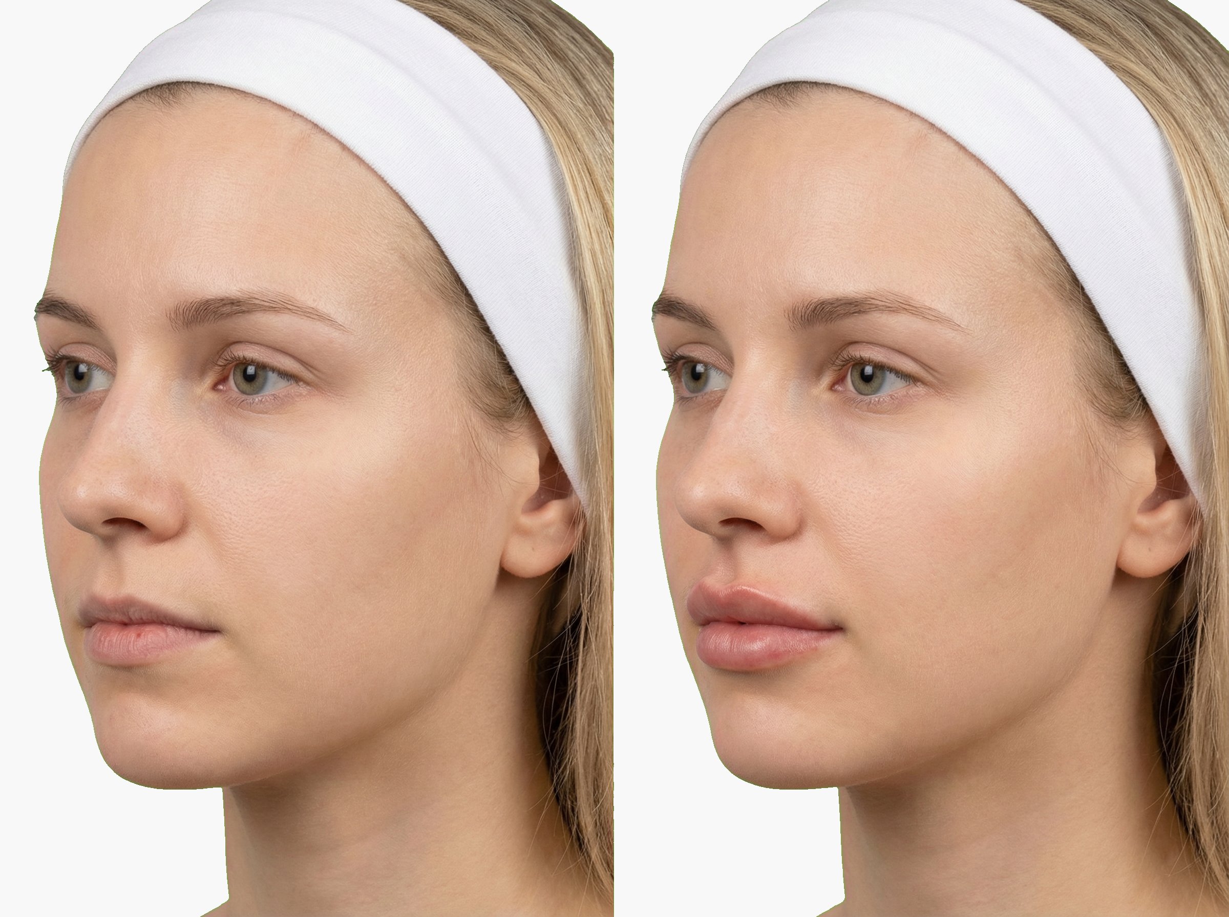 Antes y después de relleno de labios con ácido hialurónico