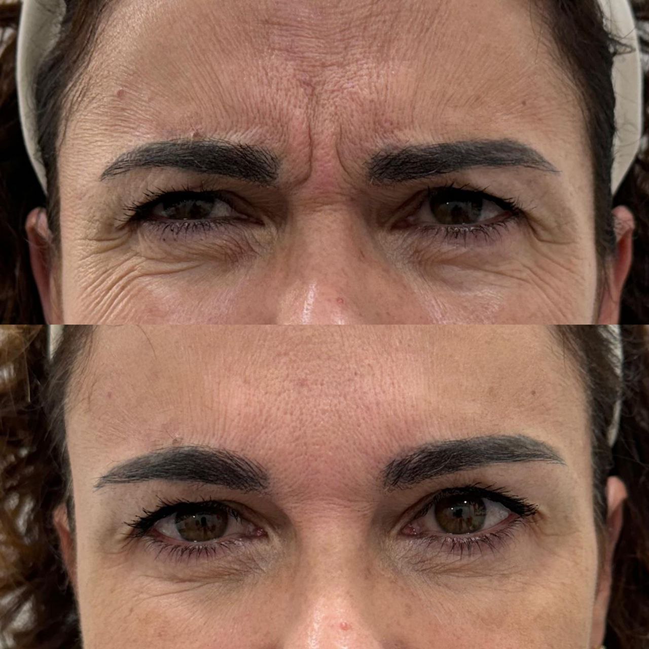 Antes y después de tratamiento de botox en frente y entrecejo