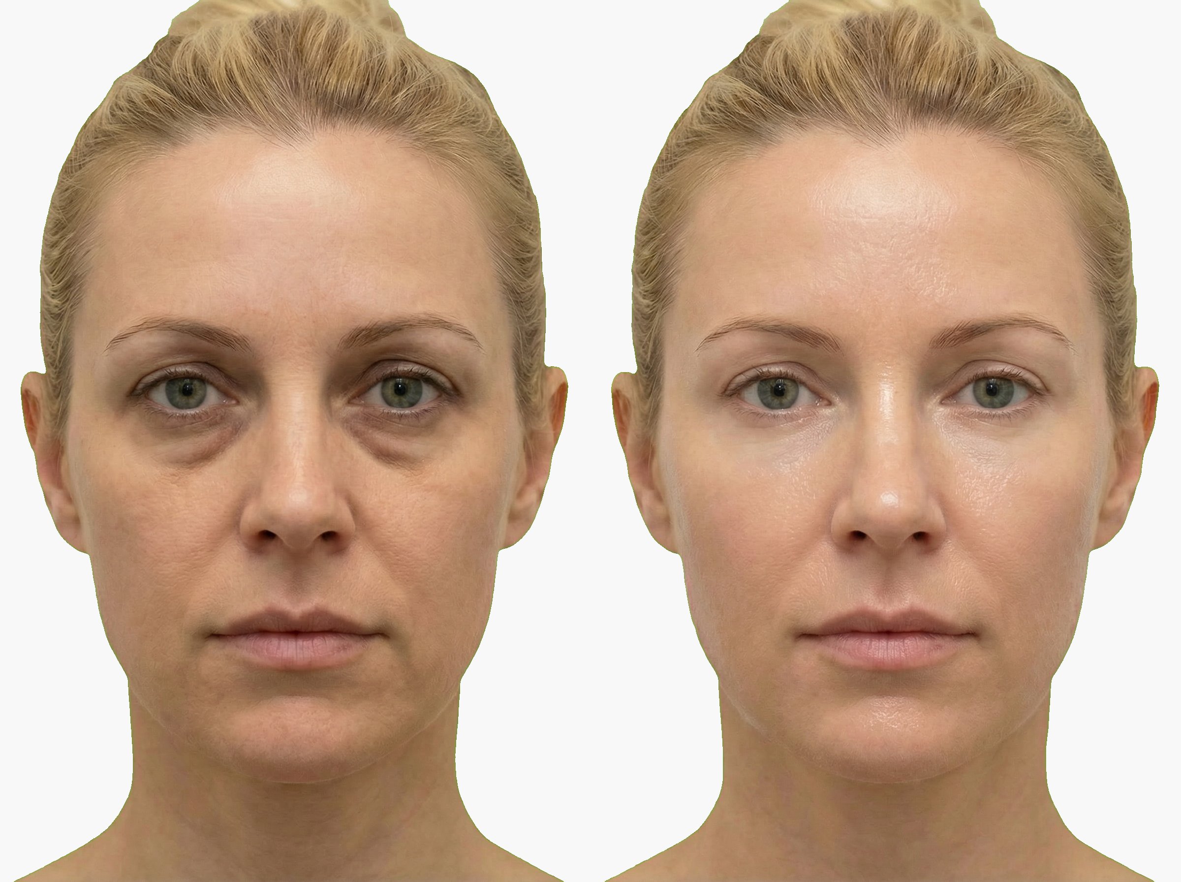 Antes y después de tratamiento de hidratación vital para luminosidad