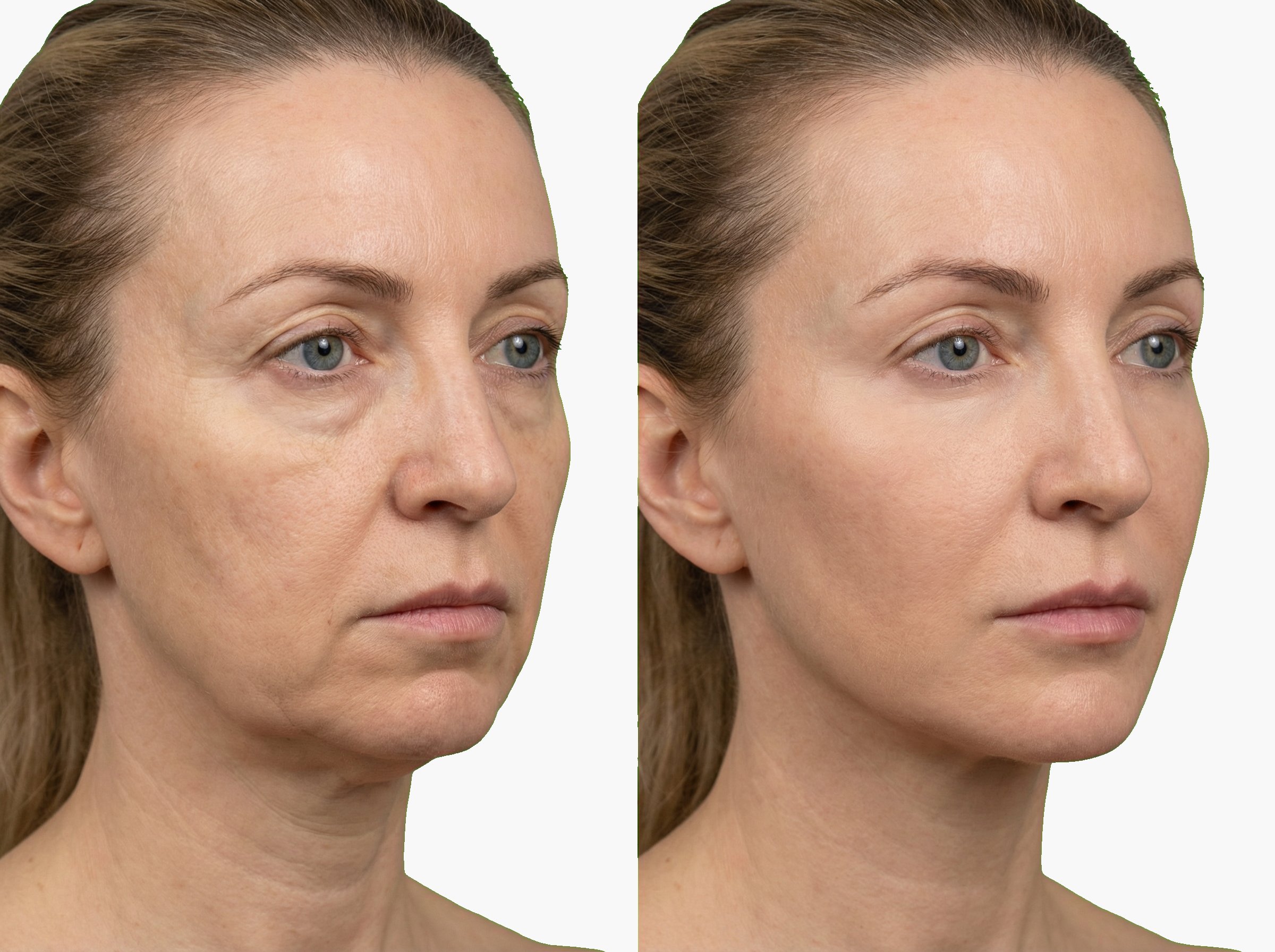 Antes y después de efecto lifting con hilos tensores