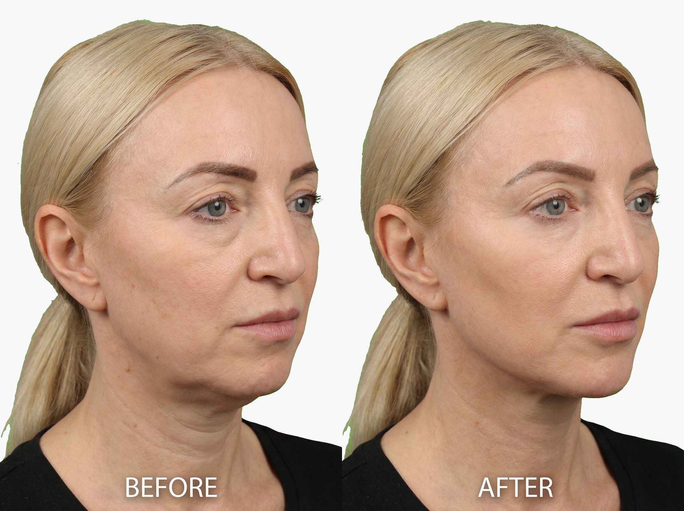 Antes y después de redefinición del óvalo facial con hilos tensores