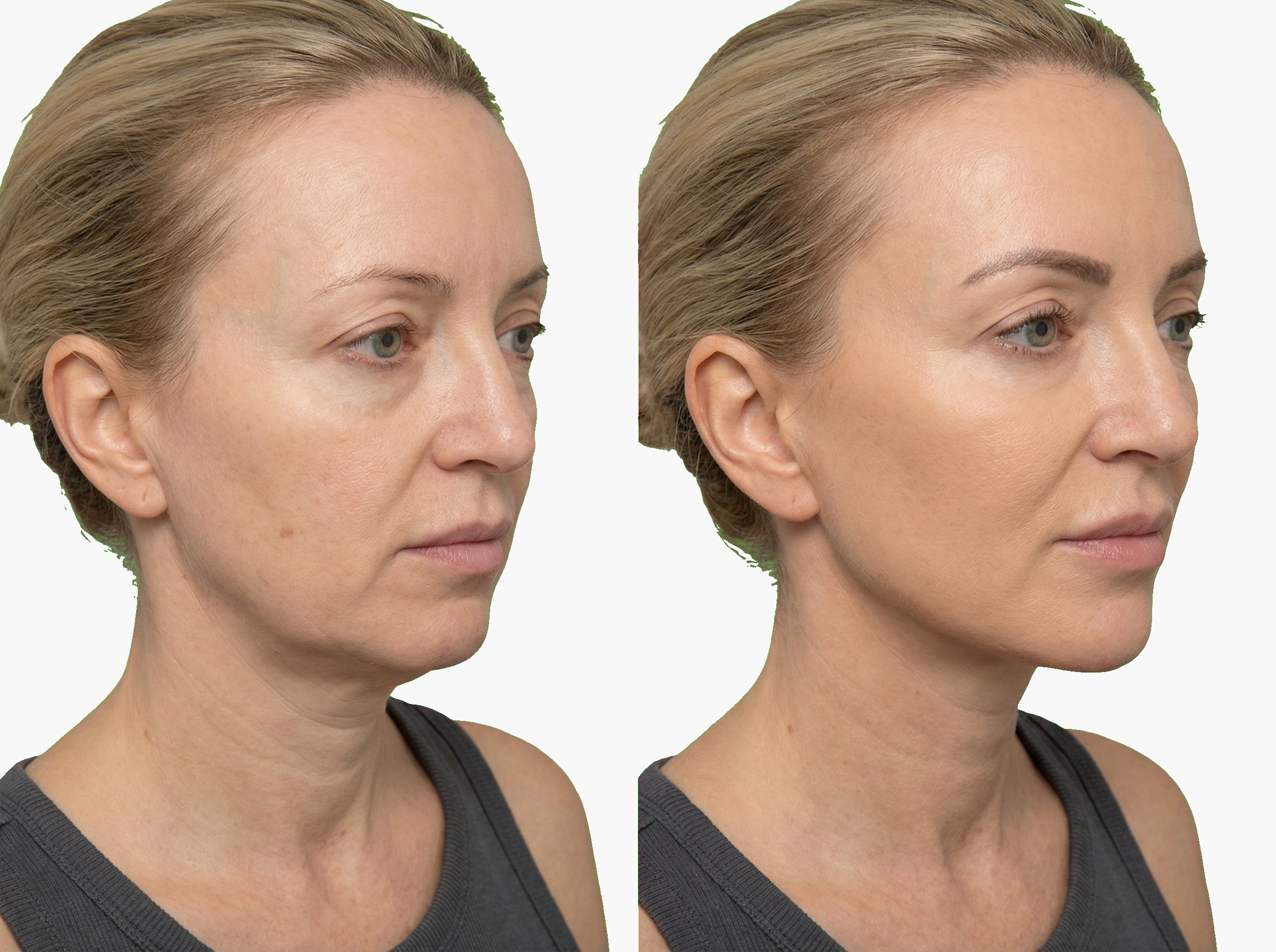 Antes y después de definición de mandíbula con Radiesse